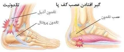 علت درد پاشنه پای سمت چپ چیست؟