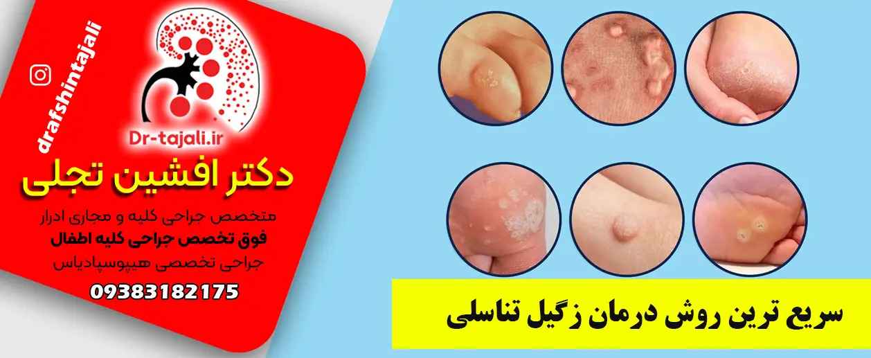 دکتر تجلی فوق تخصص درمان زگیل تناسلی اصفهان|کلینیک ارولوژی