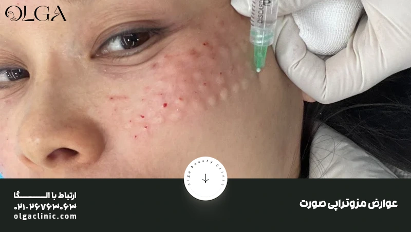 عوارض مزوتراپی صورت؛ هر آنچه باید پیش از انجام بدانید